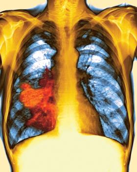 Na pokolorowanym zdjęciu rentgenowskim czerwony obszar to rozrośnięty rak prawego płuca.