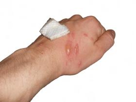 Uszkodzenia skóry po kontakcie z barszczem.