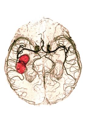 Obraz ukazujący miejsce wystąpienia udaru mózgu.