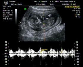 Skan badania ultrasonograficznego serca 13-tygodniowego płodu.