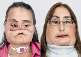 Connie jeszcze dwa lata temu miała zdeformowane 80 proc. twarzy. Po przeszczepie kobieta znów wróciła do życia.