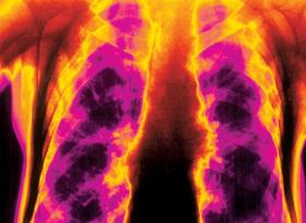 Płuca narażone są na dym oraz szkodliwe miazmaty, które wdychamy z powietrza. Zdjęcie płuc 85-latka.