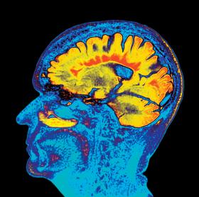 Barwne obrazowanie metodą rezonansu magnetycznego mózgu ze stwardnieniem rozsianym.