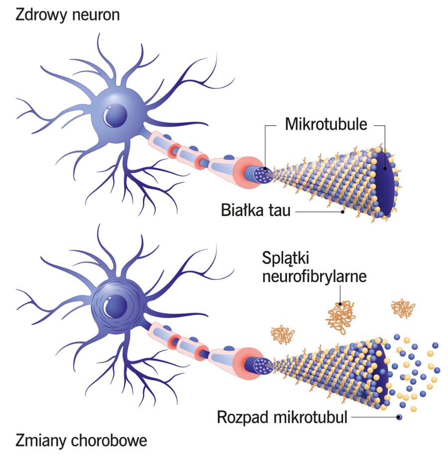 Zmiany w białku tau powodują rozpad mikrotubul w neuronach.