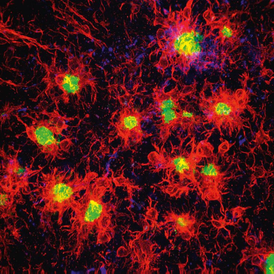 U chorych na ­alzheimera swierdzono większą liczbę ­komórek mikrogleju (czerwony). Na zdj. ­otaczają one blaszki beta-amyloidu (zielone).