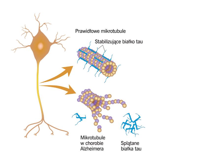 Nieprawidłowa konformacja białka tau powoduje, że w neuronach rozpadają się mikrotubule.