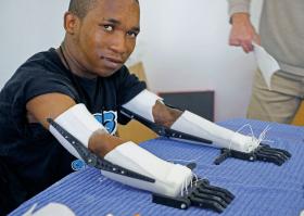 Protezy wykonane za pomocą drukarki 3D