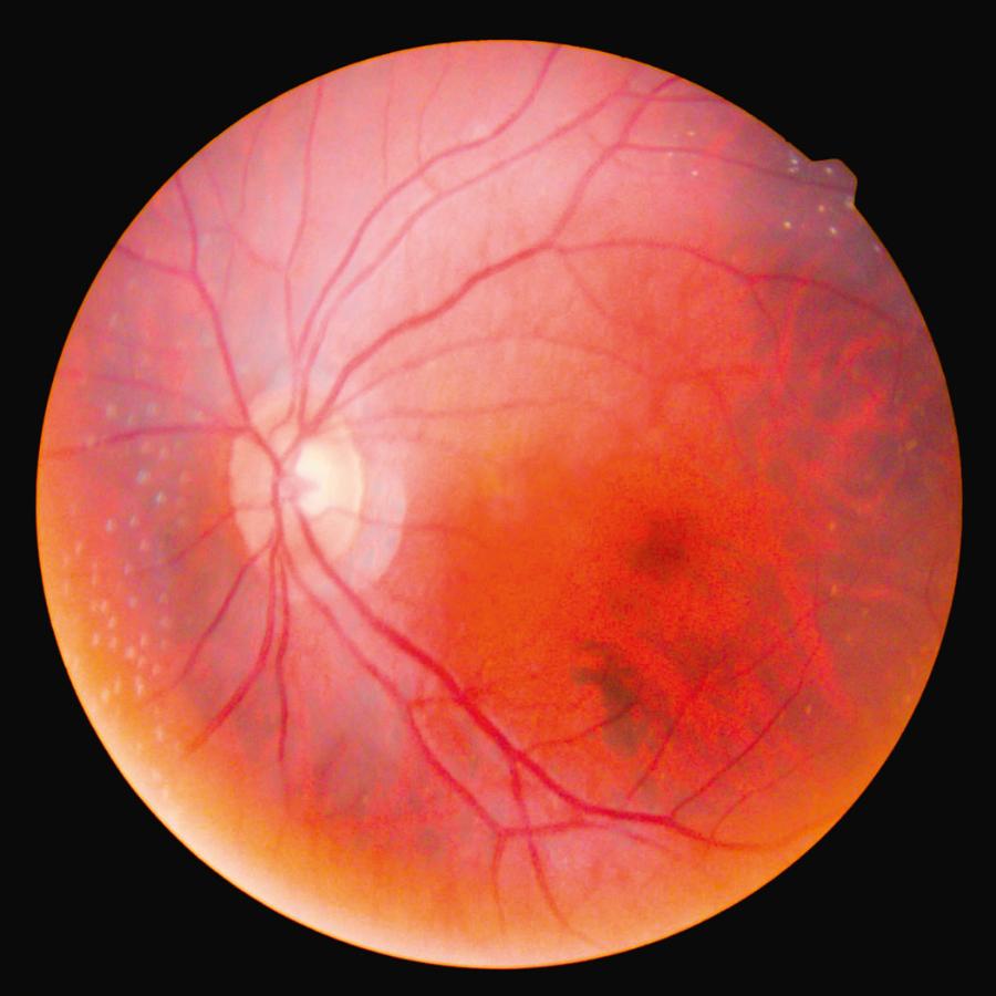 Fotografia dna oka. Widoczne tarcza nerwu wzrokowego (jasny punkt po lewej) i naczynia krwionośne.