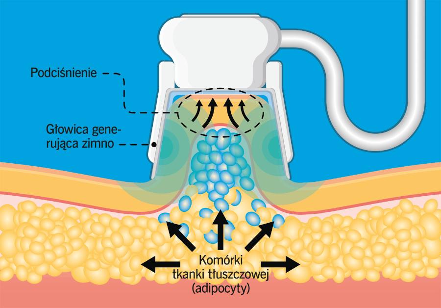 Zabieg kriolipolizy ­niszczy komórki tłuszczowe.