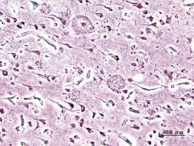 Obraz histopatologiczny płytek starczych w korze mózgu pacjenta z chorobą Alzheimera o początku przed okresem starzenia.