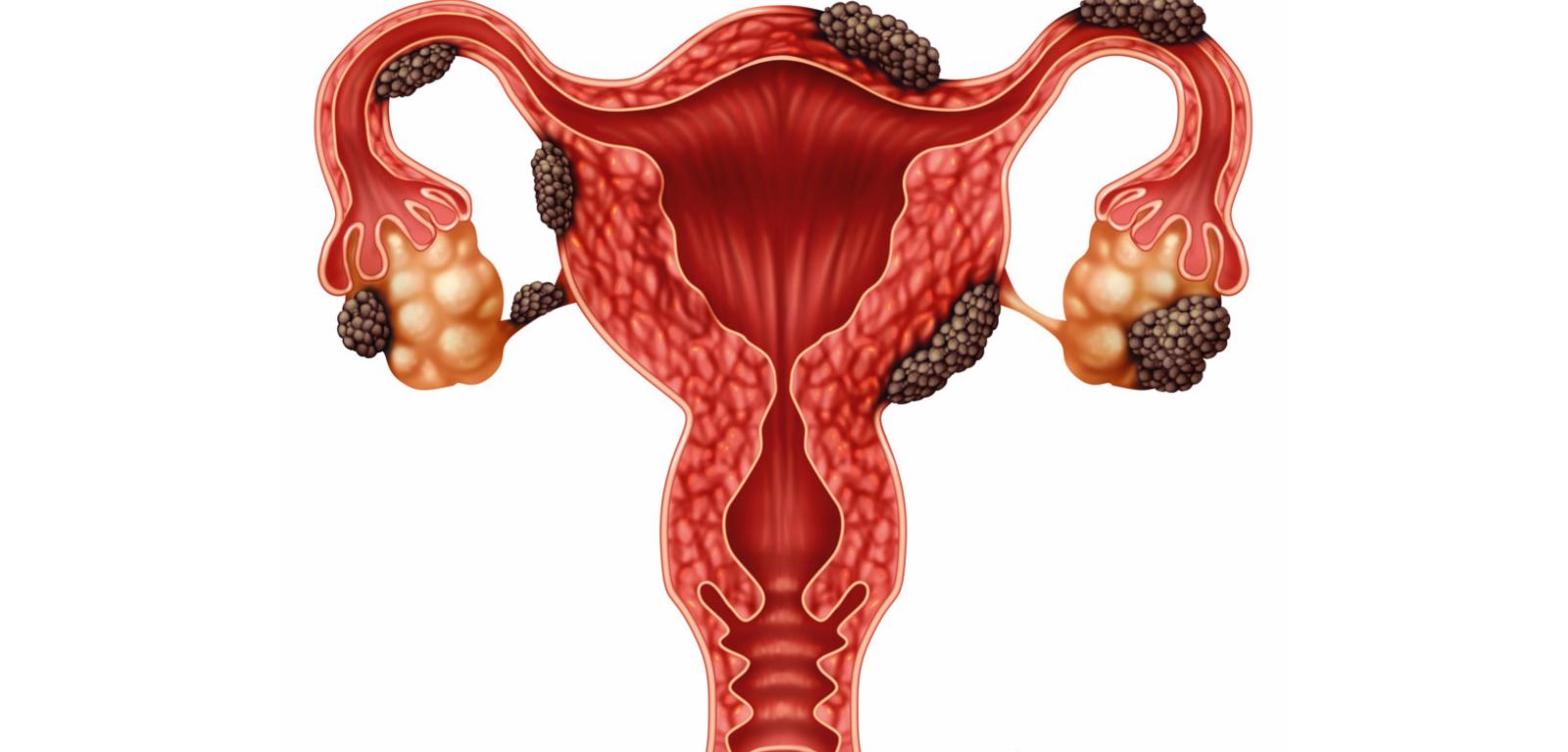 Komórki endometrium (czarne) rozwijające się na jajnikach, macicy i jajowodach.