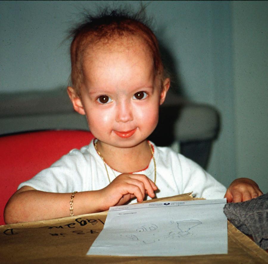 Tak wygląda dziecko chorujące na progerię w wieku 6 lat.