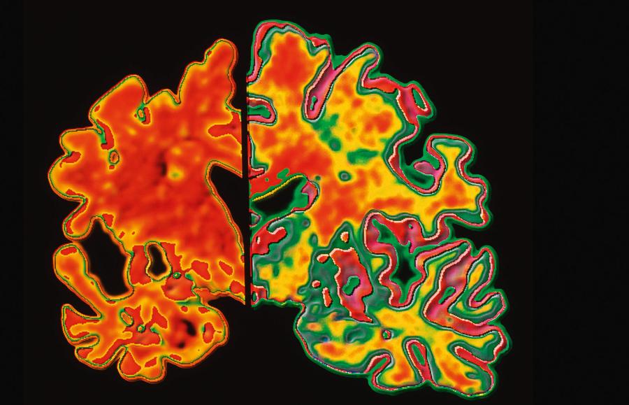 Przekroje mózgu osoby z alzheimerem (lewe, widać degenerację) i zdrowej. Zdjęcia obrobione komputerowo.