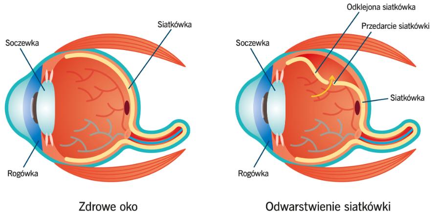 Odwarstwienie siatkówki przebiega bezboleśnie i często jest wykrywane po kilku latach. Typowym sygnałem są błyski, mroczki i kształty w polu widzenia. Przedarciowe odwarstwienie siatkówki pojawia się, gdy płynna część ciała szklistego dostaje się pod siatkówkę.