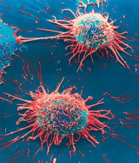 Komórki raka szyjki macicy.