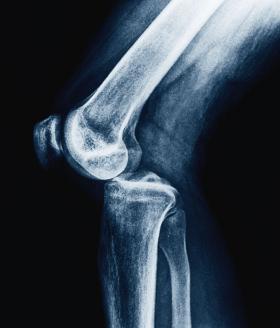 Zwichnięcie stawu kolanowego.