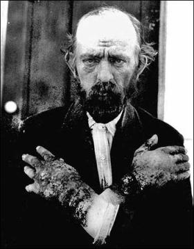 Mężczyzna chory na pelagrę. Widoczne zaawansowane zmiany skórne na grzbietach rąk.