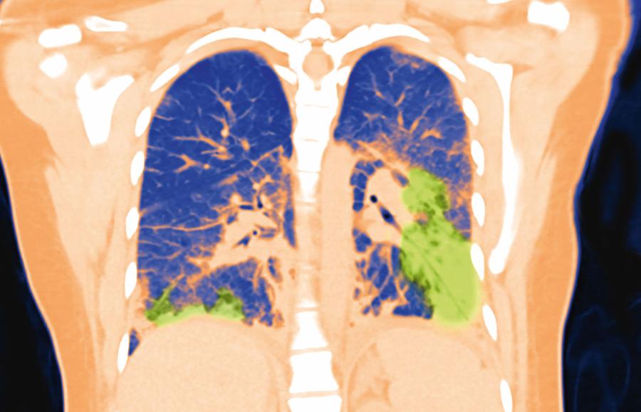 Zniszczone płuca 19-­latki – efekt choroby EVALI, spowodowanej używaniem nielegalnych liquidów do e-papierosów