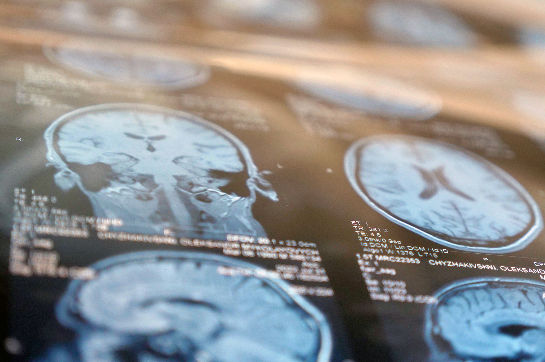 Stwardnienie rozsiane ma wspólne genetyczne podłoże w różnych populacjach