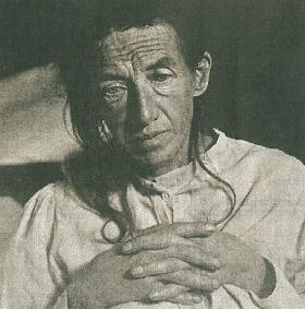 Augusta Deter. To jej przypadek pozwolił Aloizowi Alzheimerowi zdiagnozować nową chorobę w 1906 r.