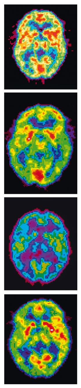 Obrazowanie mózgu w fazie (od góry): REM, wybudzenia, głęboki sen, sen normalny.