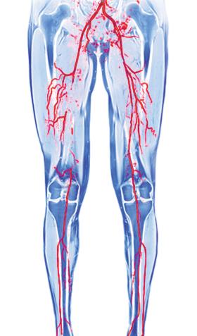 Zakrzepica kończyn dolnych widoczna w rezonansie magnetycznym.