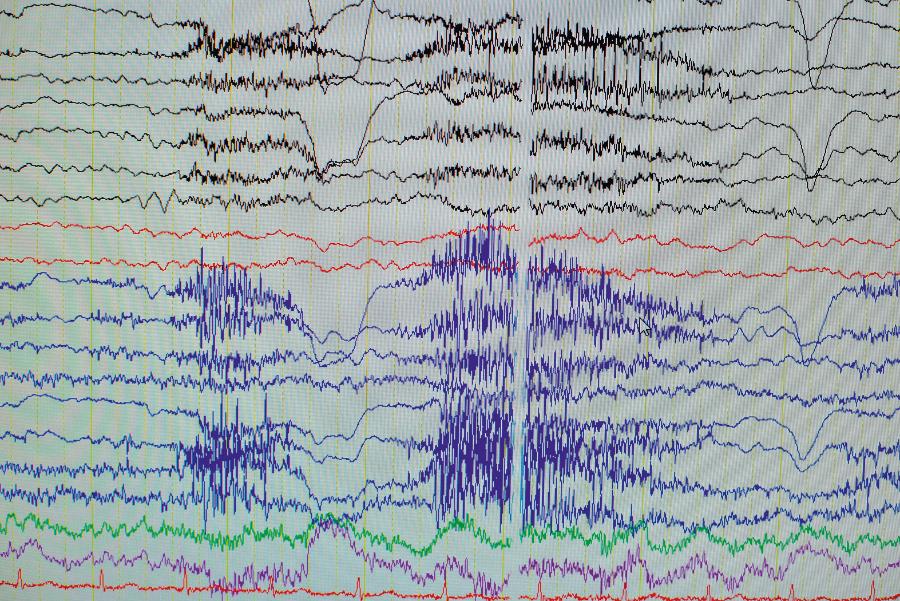 Zapis sygnału EEG. W warunkach fizjologicznych powstają fale mózgowe o częstotliwości 1–100 Hz oraz amplitudzie od 5 do kilkuset µV.