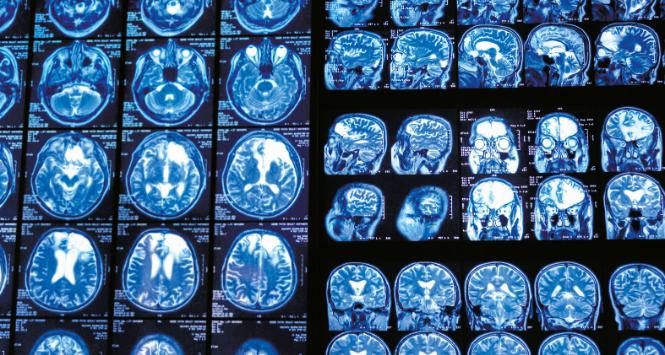 Zwiększona liczba rozpoznań u ludzi młodych może wynikać z obniżania wieku badań przesiewowych.