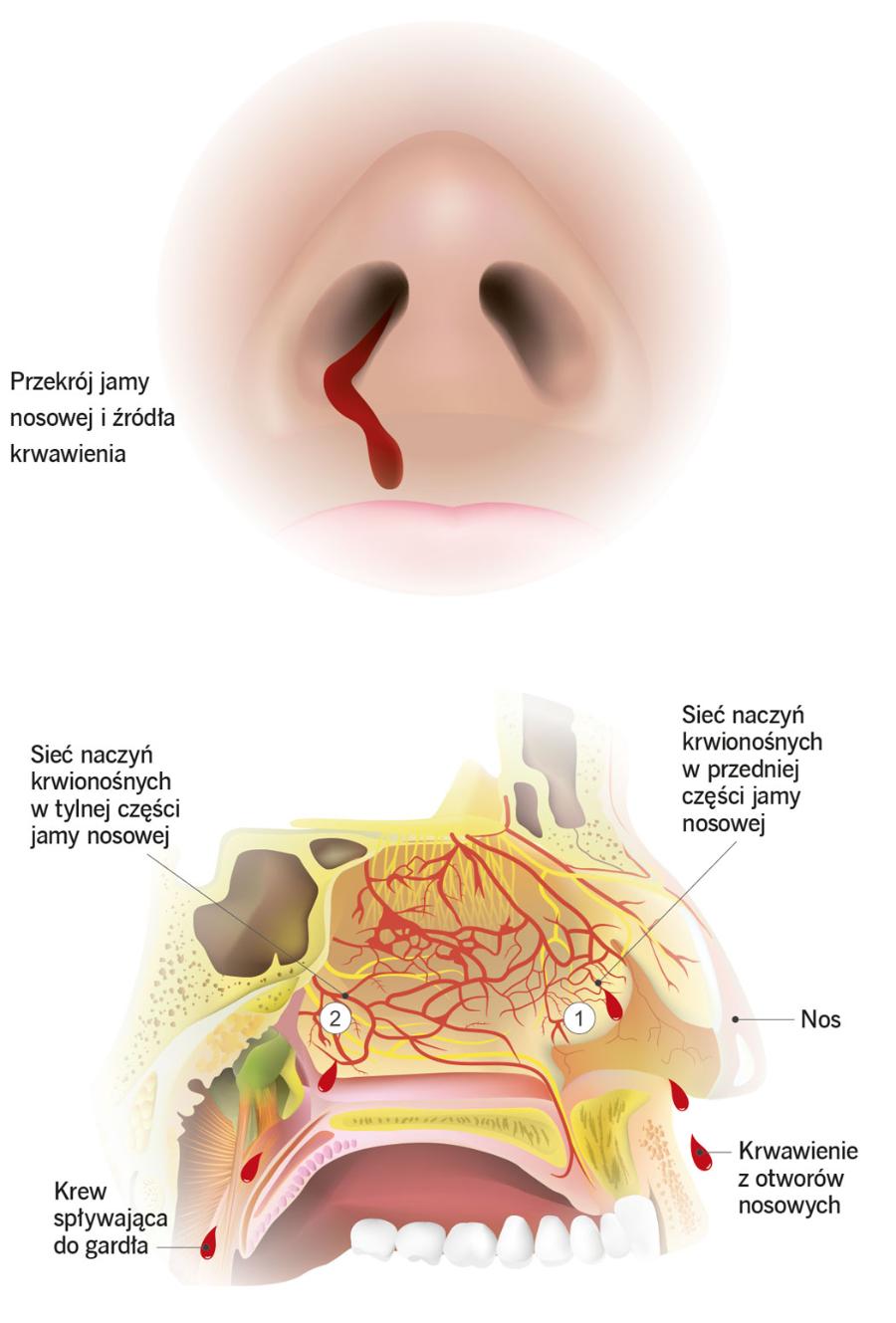Przekrój jamy nosowej i źródła krwawienia.