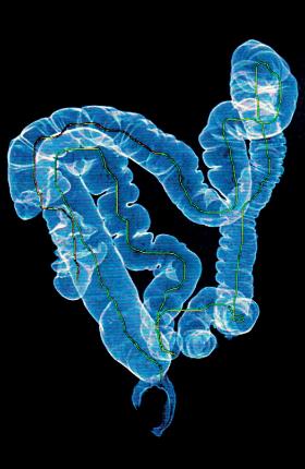 Obraz jelita grubego w trakcie kolonoskopii.