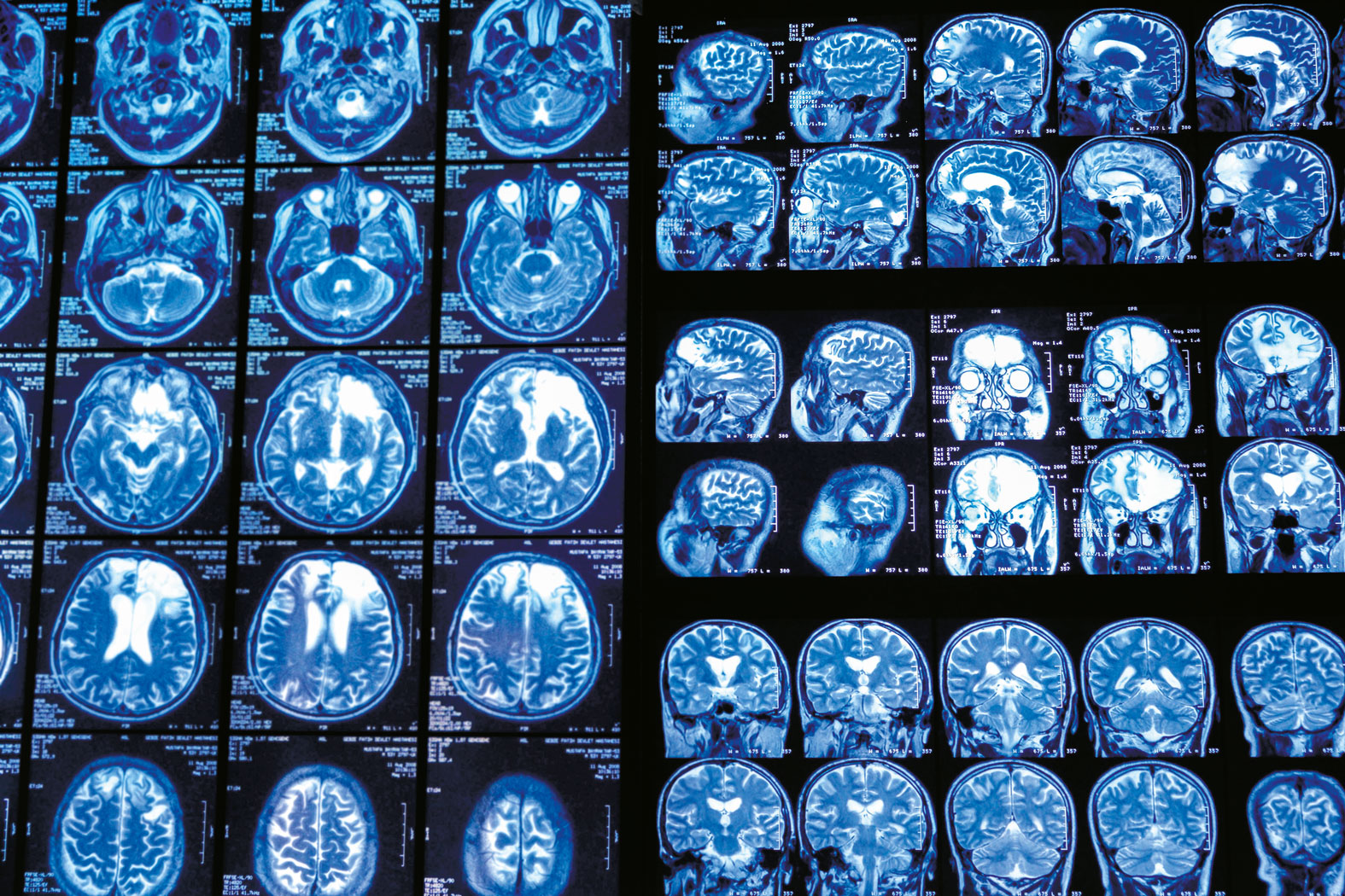 Rak młodnieje. Złośliwą diagnozę słyszą coraz częściej 30- i 40-latki. | Rak młodnieje