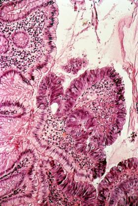 Pobrana od pacjenta tkanka z komórkami rakowymi, pod mikroskopem.