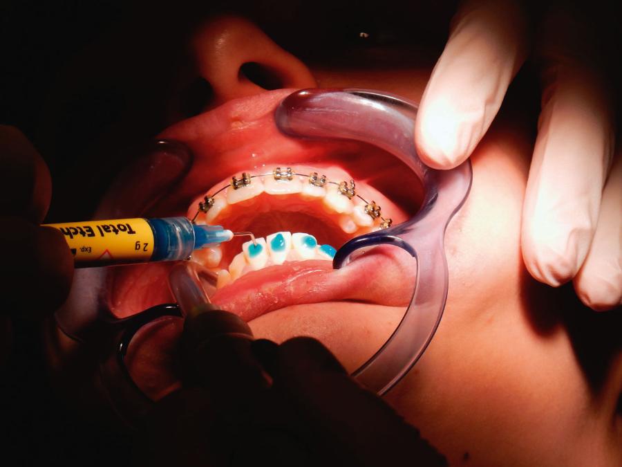 Specjalny klej ­dentystyczny do ­mocowania aparatu ortodontycznego.