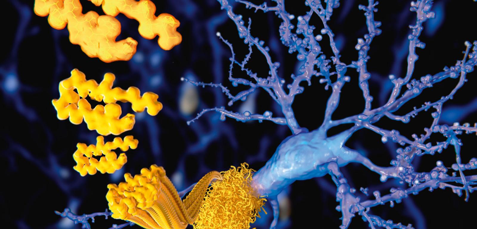Złogi amyloidowe (żółty) odkładające się na neuronie.