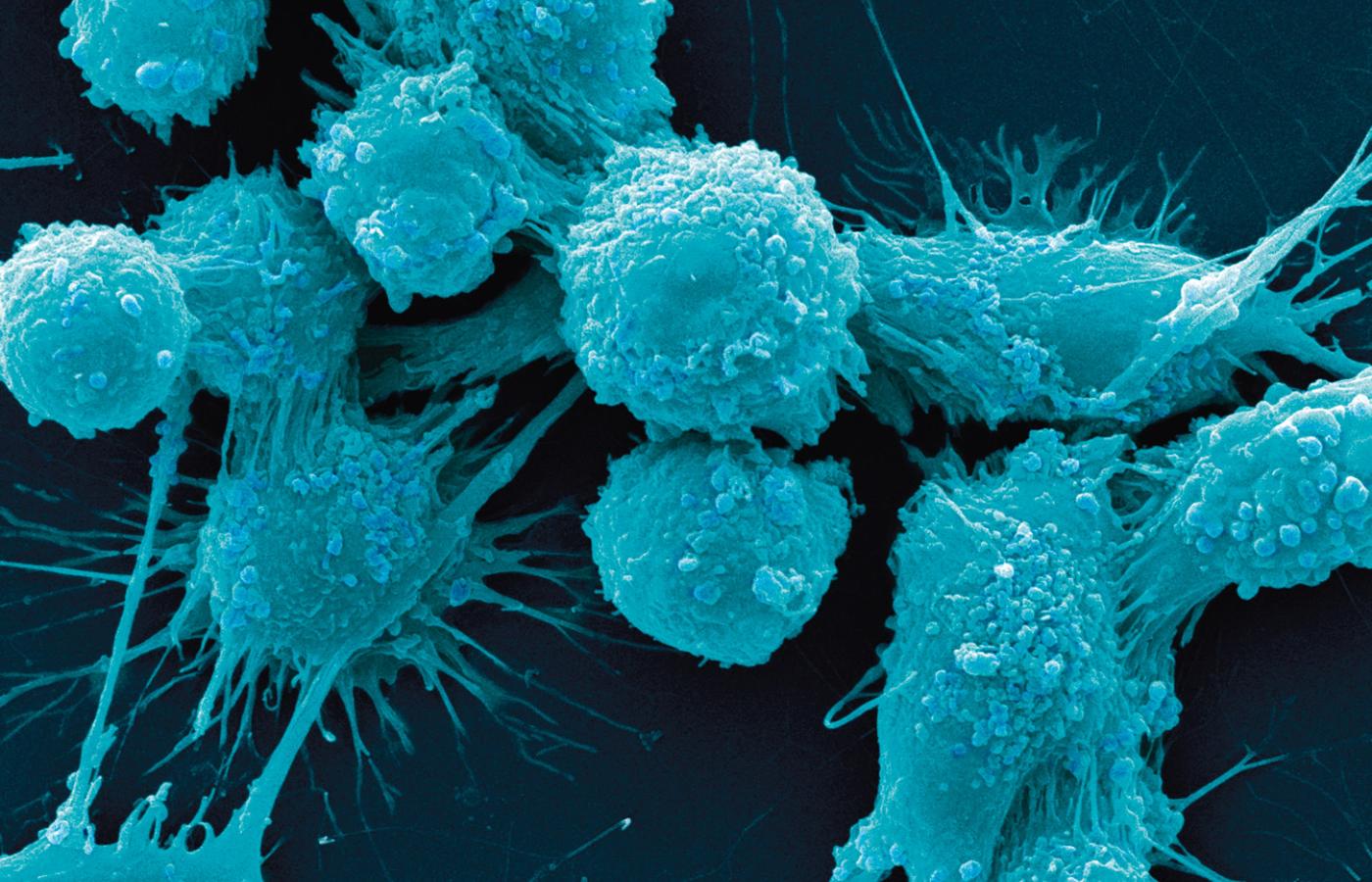 Komórki raka prostaty.