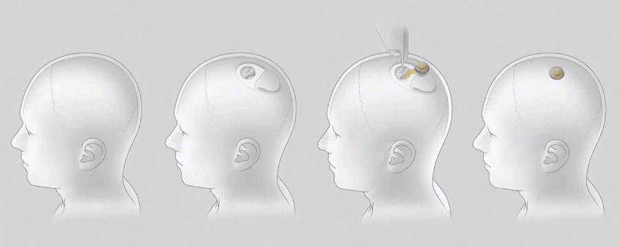Etapy implantacji chipu, pokazane przez Neuralink podczas prezentacji 28 sierpnia 2020 r.