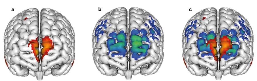Podglądanie mózgu
Badania osób z urazami mózgu7, które zaraz po takim uszkodzeniu porzuciły palenie, wskazały na związek pomiędzy aktywnością przedniej kory przedczołowej a zerwaniem z nałogiem (a). Analiza tych regionów mózgu, które były pobudzane podczas przezczaszkowej stymulacji magnetycznej w celu porzucenia nałogu nikotynowego (b), a których celem miała być kora wyspowa, wykazała, że w ten sposób idealnie stymulowano korę przedczołową przednią (c). To może tłumaczyć, dlaczego u części nałogowych palaczy terapia okazała się skuteczna.