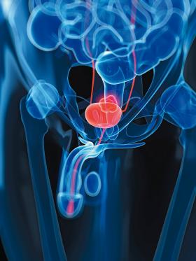 Rak gruczołu krokowego to nowotwór, który w początkowej fazie - gdy mozna go usunąć w całości - nie daje żadnych dolegliwości.