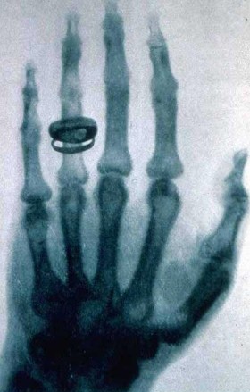 Zdjęcie rentgenowskie dłoni Rudolfa Kollikera wykonane przez Roentgena na posiedzeniu Physical Medical Society w Würzburgu 23 stycznia 1896.