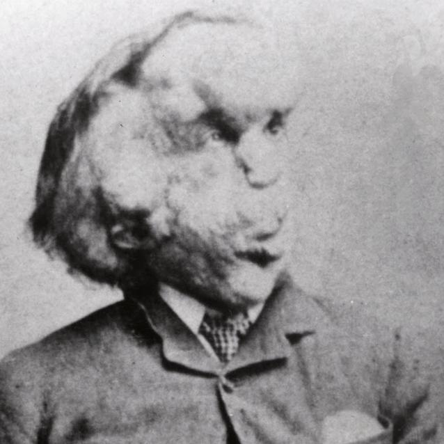 Joseph Merrick urodził się zdrowy, dopiero w wieku 5 lat jego ciało zaczęło się zmieniać.