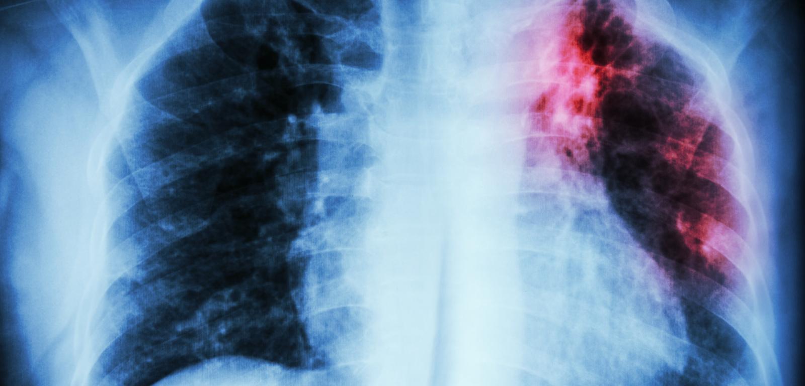 Gruźlica płuc. RTG klatki piersiowej: infiltracja śródmiąższowa w jednym górnym płucu spowodowana zakażeniem Mycobacterium tuberculosis.