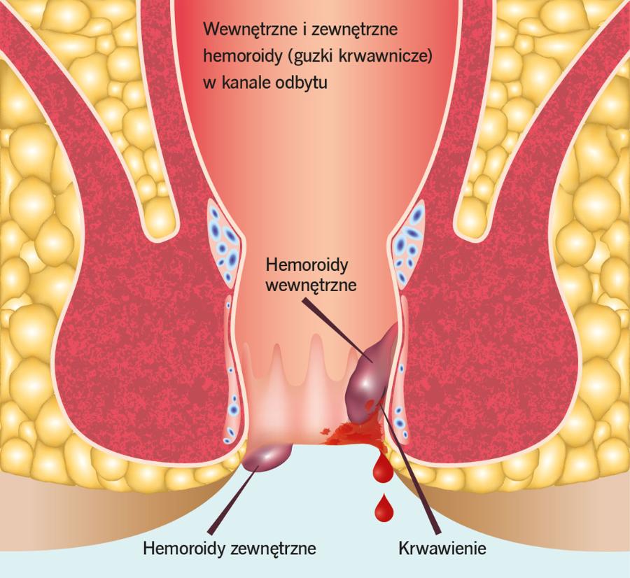 Wewnętrzne i zewnętrzne ­hemoroidy (guzki krwawnicze) w kanale odbytu.