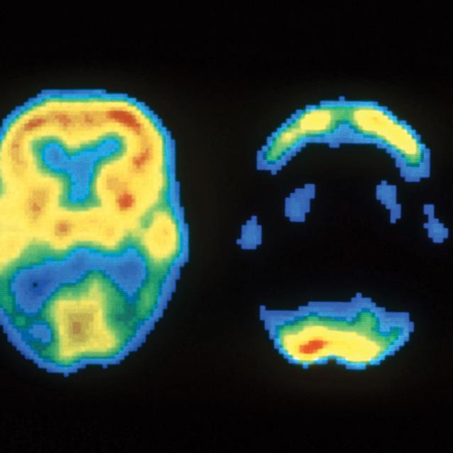 Uzyskane techniką PET skany mózgu człowieka zdrowego (po lewej) oraz mózgu chorego na alzheimera (po prawej).