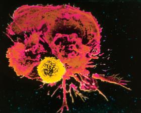 Obraz spod mikroskopu elektronowego z widocznym w kolorze żółtym cytotoksycznym limfocytem T-CD8, który został odblokowany i atakuje komórkę nowotworową (w kolorze czerwonym).