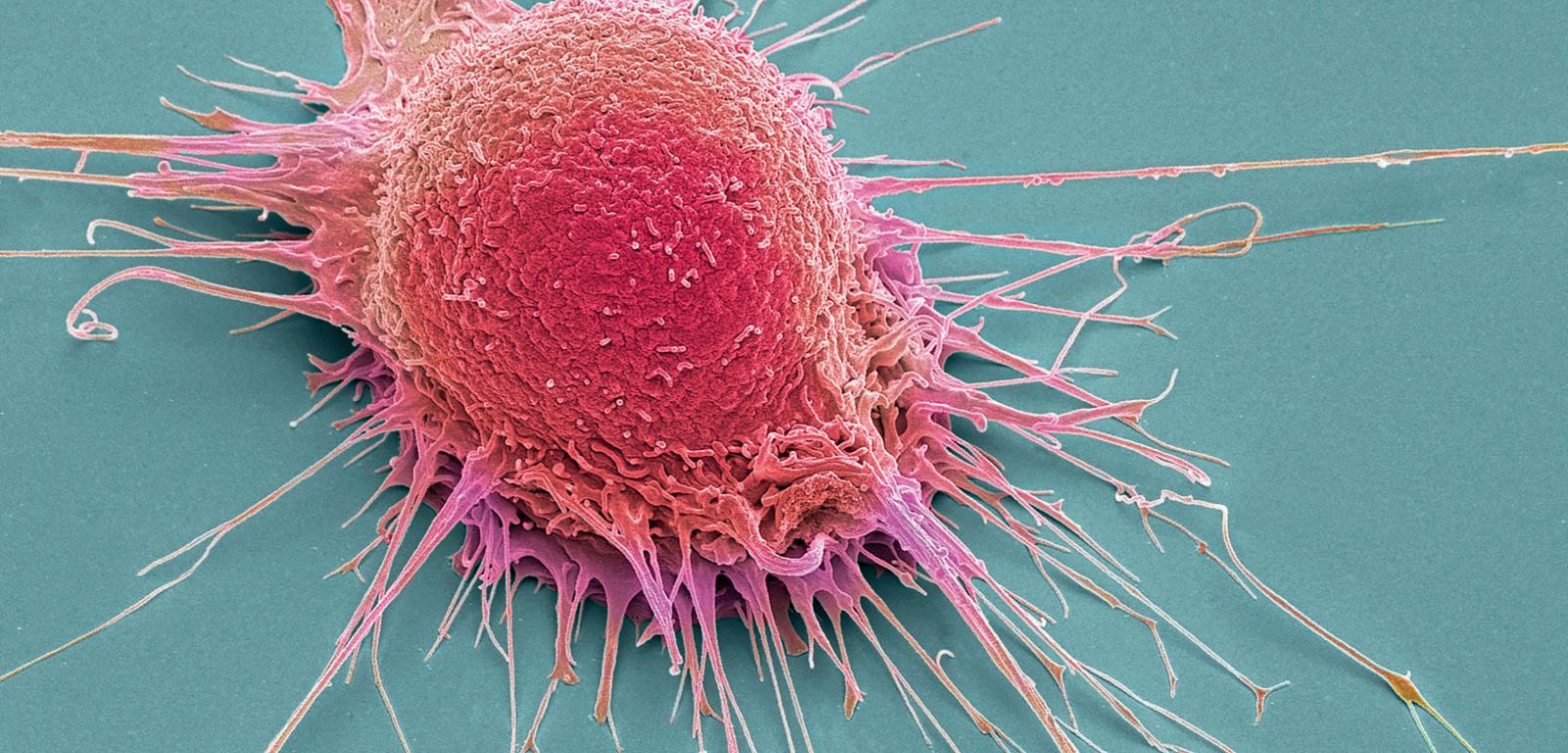 Komórka raka gruczołu krokowego, uwidoczniona pod skaningowym mikroskopem elektronowym.
