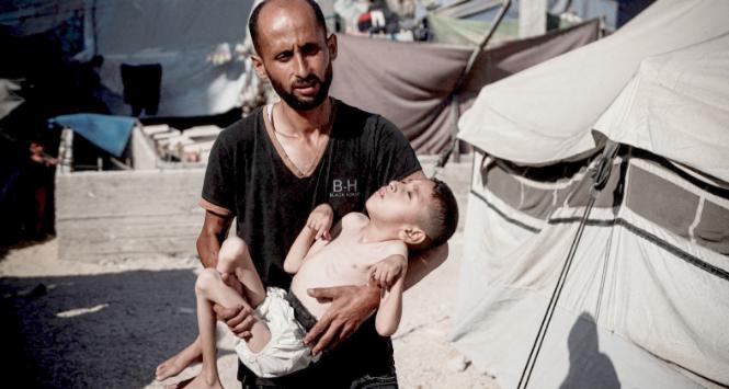 Sześcioletni Malik Nidal Saad cierpi na poważne niedożywienie. Uciekł z rodziną z Bajt Lahia. Z powodu izraelskiej blokady Strefy Gazy waga chłopca spadła z 15 do 7 kg.