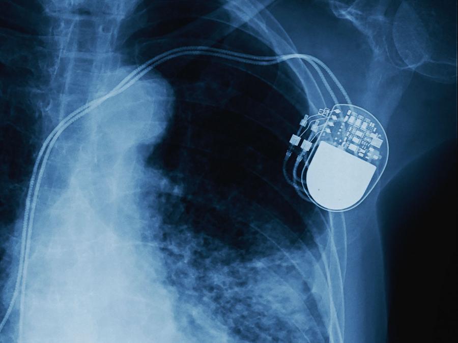 Zdjęcie rtg implantu rozrusznika (widoczne elektrody prowadzące do serca).
