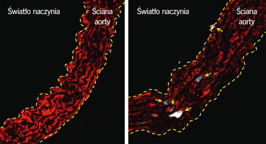 Napięcie śródbłonka w komórkach mięśni gładkich (czerwone) w aorcie myszy zdrowej (po lewej) i cierpiącej na progerię (po prawej).