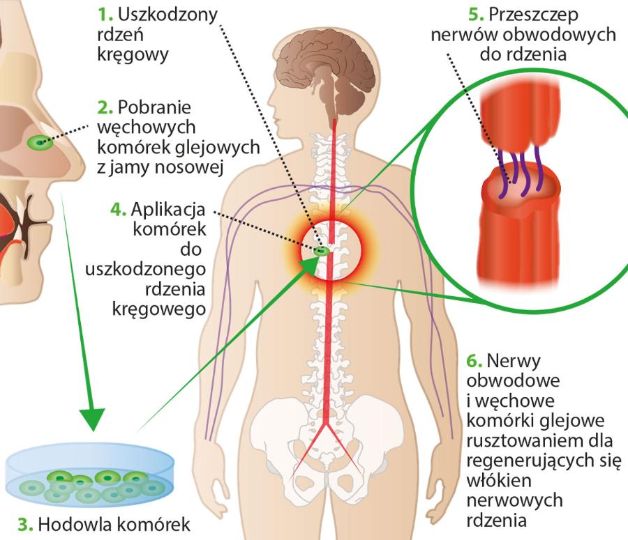 Regeneracja włókien nerwowych ­dzięki ­węchowym komórkom glejowym.