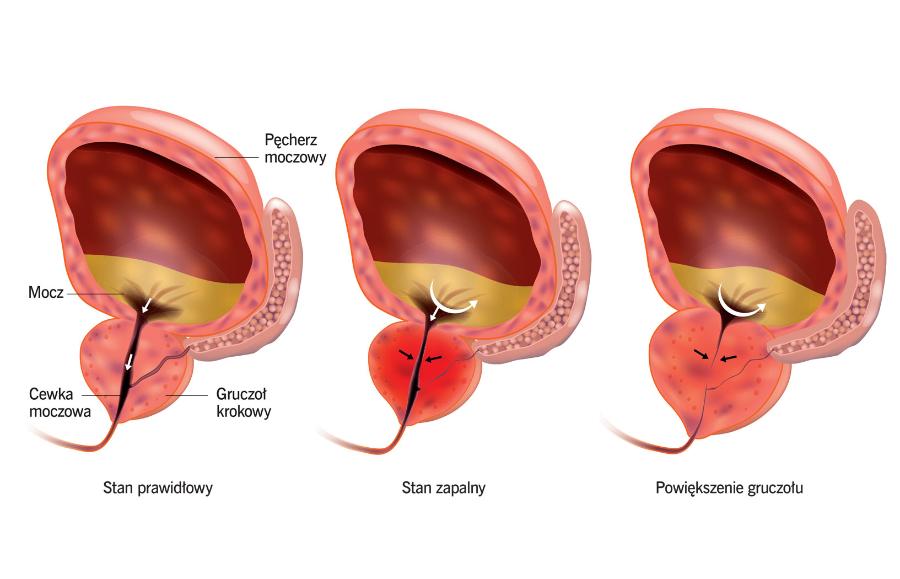 Zmiany gruczołu krokowego (prostata, stercz).
